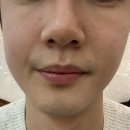 메디플러스 의원 | 젠틀맥스프로플러스 남자 수염 제모 1회차 후기 - 해피메디의원
