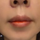 행복한 멍이세상 | 팔자주름 고민 끝! 부산피부과추천 ✨ 쥬베룩볼륨 실제 후기 (내돈내산)