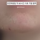 누가한의원 | 가산 새살침 추천 여드름 흉터 한의원 재생침 내돈내산 효과 후기