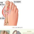 통풍 및 정보통증 이미지