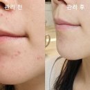 유과 | 생리전 턱 여드름 생기는 이유과 관리 성공 후기
