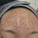 강한한의원 | 천안여드름치료전문한의원 여드름 관리 3주 간의 변화기록 (내돈내산후기)