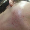 리유한의원 | 리유한의원 모낭염 치료 후기 신사점까지 간 이후