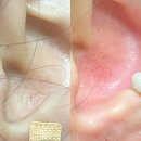 나실약국 | 귀블랙헤드 충격 ㅠㅠ 클렌징오일 세안으로 깨끗하게 관리하기 (혐짤주의) 귀 블랙헤드 생기는 이유