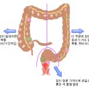 대장암 colorectal cancer 이미지