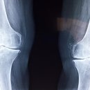 구의아차산마취통증의학과의원 | 무릎 안쪽 통증 원인과 대처법 알아보기