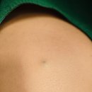 예스항외과의원 | 영등포구 피지낭종, 레이저로 흉터 없이 뺄 수 있나요?