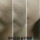 평택미SKIN | (평택 뉴스킨) 클렌징기계의 신 "루미스파"