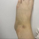 주작나무한의원 | 주작나무 한의원 발목염좌 치료후기