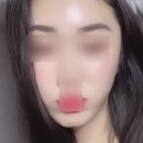 압구정미라클의원 | 압구정성형외과 실리프팅 미친 효과로 v라인 만든 후기 부작용, 통증, 효과