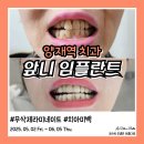 조아치과기공소 | 양재역치과 앞니 임플란트 무삭제 라미네이트 및 치과 치아미백 후기