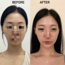 총총총 | [청담 피부과] 티타늄 리프팅 내돈내산 솔직 후기 총총총...