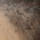 헤드샷모이스 | SMP 여자 헤어라인문신 받고 3년 후 상태 후기 (유지력, 장단점, 부작용 번지는 이유)