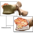 ﻿뼈암.골육종의 원인 이미지