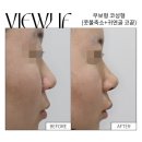 무보 | [대전 뷰리프] 코 수술 일주일 째 리얼 후기(콧볼축소,무보형 코성형)