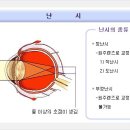 난시(亂視) 이미지