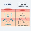 임플란트 수술 후 담배 언제부터 피울 수 있나요? | 수성구 치과 원장 직접 답변