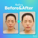 리스토리강남 리프팅 가격만 보고 선택하면 생기는 일, 직접 알아보니 기준이 달라졌습니다