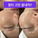 역삼개나리래미안㉵ | 역삼 닥토필 1회 피부관리 효과 있을까?