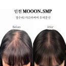Review_인천 Mooon SMP : 정수리/가르마커버 두피문신 후기
