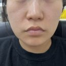(주)텐이얼즈애프터 | 의정부 피부과 20대 탄력유지 고현정리프팅 텐써마 후기