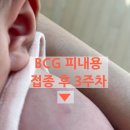 이호성소아청소년과 | (대전 유성구 보건소, 이호성 소아과) 1차 영유아 검진 & BCG(+흉터), B형간염 접종 후기