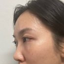 [내돈내산]답답해서 상세히 올리는 눈밑지방재배치 리얼후기#2✨👀 (3-7일차)