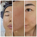 평택피부관리 미모에스테틱왁싱 MIMO LAB 리프레쉬필 후기 _ 깐달걀이란 피부가 이런거구나!!!!
