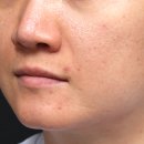 디엠피부과의원 | 연신내피부과에서 레디어스 스킨부스터 받아본 솔직 후기 (한 달 변화)