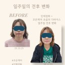 조은의료기기 | 조은케어 초음파 디바이스 물혹, 피부 일주일 체험 변화