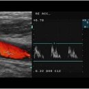 Carotid artery 이미지