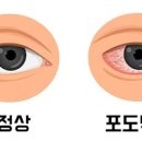 포도막염 증상 원인 및 치료 (눈충혈 날파리증 눈부심현상, 안구통증 오른쪽 왼쪽 눈통증) 이미지