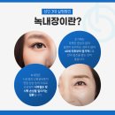 밝은희망안과의원 네이버블로그