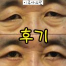 광주 비절개눈매교정 쌍꺼풀 눈재수술 눈썹하거상술 잘하는곳 비용 저렴한곳 성형외과