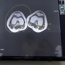 제일정형외과병원 | 어린이안짱다리 원병원 소아정형외과 다녀온 후기 (MRI비용)