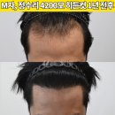 [30대모발이식 헤어라인, 정수리 머리심기] 비절개 히든컷 4500모 1년 1개월 후기 (모엠의원/M자탈모+정수리/전지훈원장) 이미지