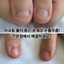 감탄(가양역점) | 마곡동 물어 뜯는 문제성 손톱무좀? 전문점 김수정뷰티 가양역점에서 해결하세요.~