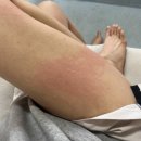 구파발성모약국 | 폐결핵 확진 및 치료 후기 (양성 판정, 엑스레이, CT, 기관지내시경, 객담검사, 산정특례, 약 부작용)