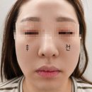 예디뷰티 | 대구북구 윤곽리프팅 전문 예디뷰티 하이푸 후기