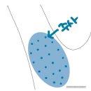세란마취통증의학과의원 | 세란통마취통증의학과의원 겨드랑이 다한증 보톡스 후기 (실비보험 청구 후기)