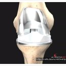 무릎관절염 수술적 치료# 관절내시경과 인공관절수술 이미지