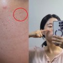해당한의원 | 도봉구 피부과 한의원 새살침 치료로 여드름패인흉터 제거 3회 후기
