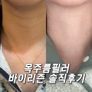 하얀멍이 | 압구정로데오 피부과 목주름바이리즌 필러 솔직후기