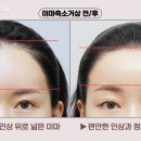 도충빌딩 | 이마축소 + 이마거상 수술 후 1개월 후기