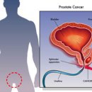 전립선암 수술 방법과 전립선암 생존율 이미지