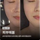 마곡에스테틱 피부에봄, 얼굴축소 V라인관리 후기