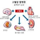 혈압 정상범위 및 고혈압 기준 이미지