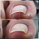 맨션531 | 대구내성발톱 | 언롤링젤로 아프지 않게 | 말린발톱 | 대봉동네일 | 반월당네일 |