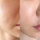 써니 | 여의도피부과에서 함은정도 받았다는 써니리프팅 내돈내산 후기! 효과 통증 가격