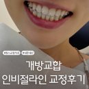 디지털닥터정치과의원 | 개방교합 인비절라인 교정후기 구로디지털단지역 원스교정치과
